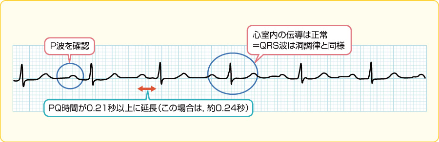 不整脈とその理解｜看護roo![カンゴルー]
